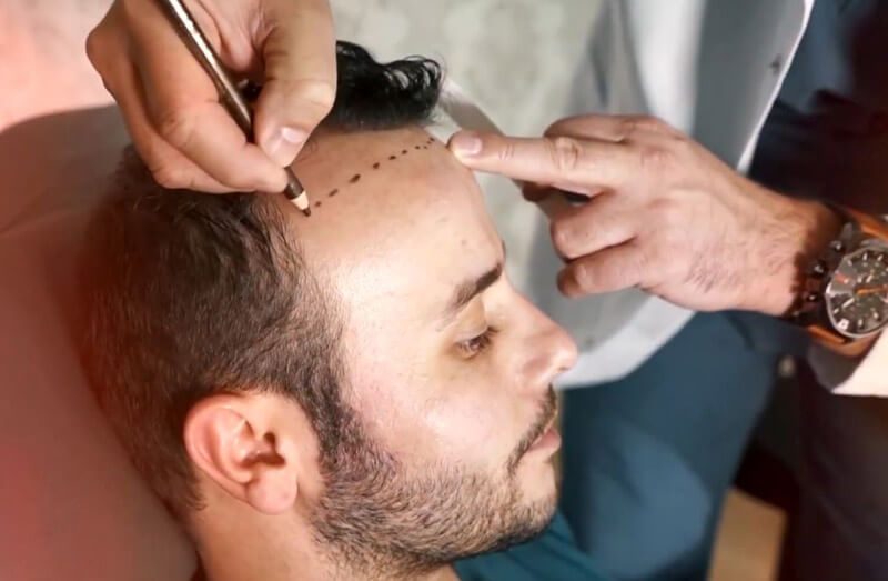 FUE matu transplantācija